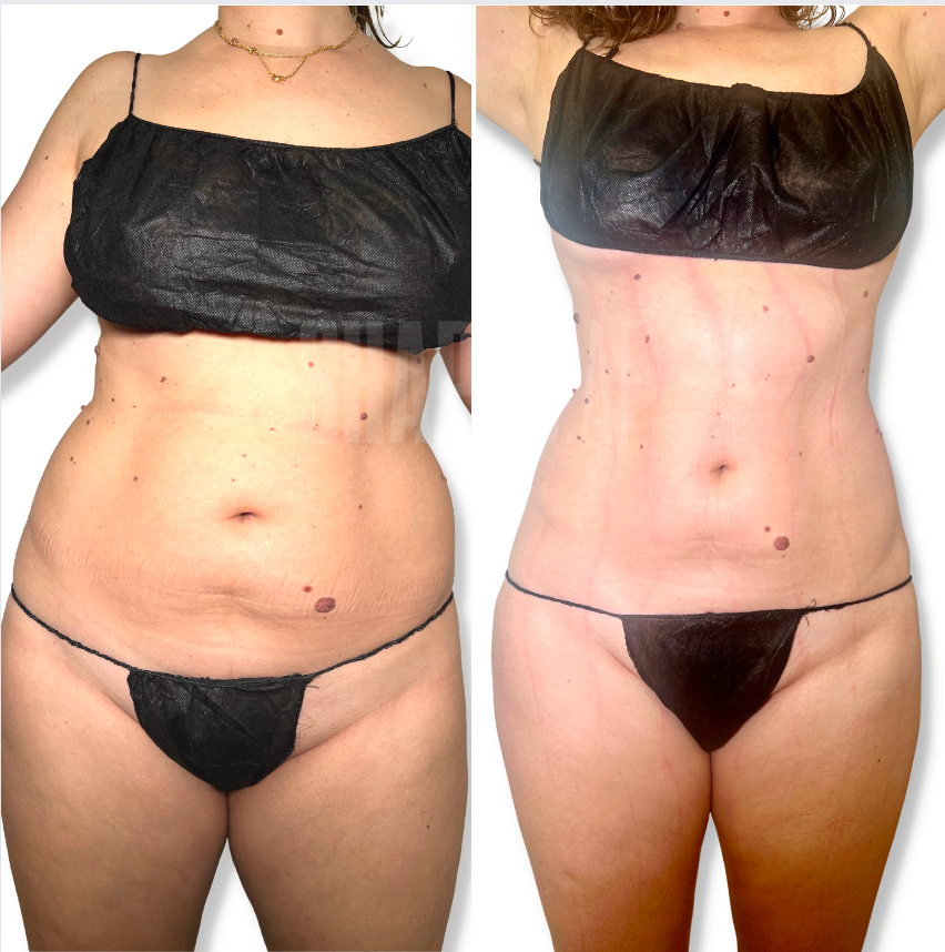 Before and after Lymphatic Sculpt: a client’s abdomen showing reduced puffiness