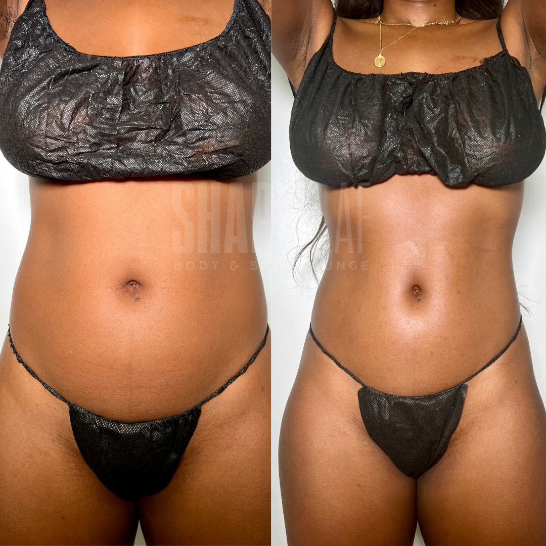 Before and after a personalized body sculpting plan: front view of a client’s abdomen and waist