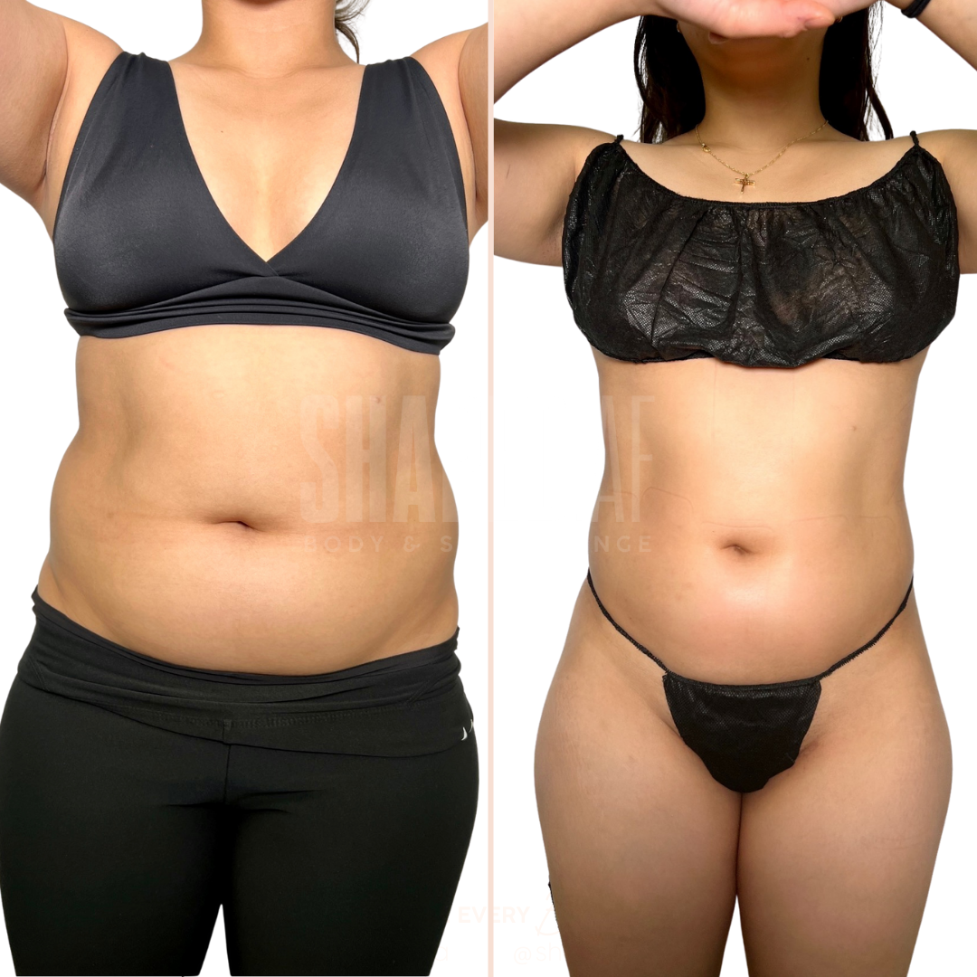 Before and after Tummy + Side Sculpt: a client’s abdomen and sides